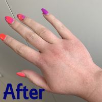 Hairdresser with contact dermatitis &quot;After&quot;