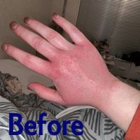 Hairdresser with contact dermatitis &quot;Before&quot;